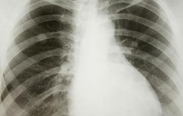 Tipos de cáncer de pulmón Rayos X del pulmón