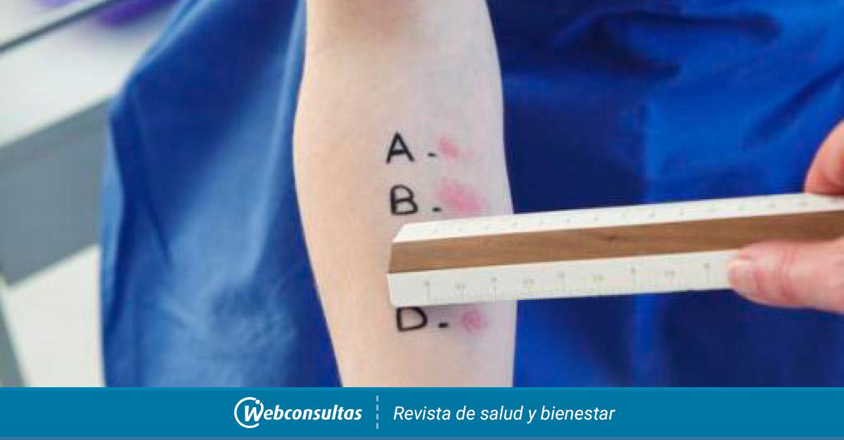 Mantoux En Qué Consiste La Prueba De La Tuberculina Pruebas Médicas 4416