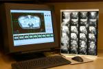 Imágenes diagnósticas de tumores cerebrales