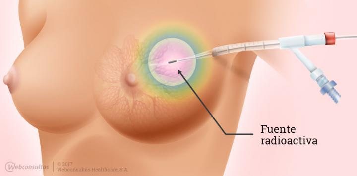 Resultado de imagen para braquiterapia