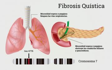 Causas de la fibrosis quística Infografía de las causas de la fibrosis quística