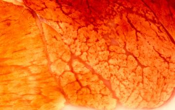 Diagnóstico de la distrofia muscular de Duchenne Diagnóstico de la distrofia muscular de Duchenne