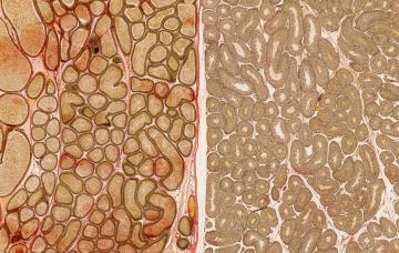 Estadificación y clasificación pronóstica del cáncer de testículo Estadificación del cáncer de testículo