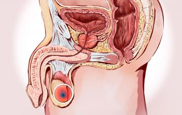 Ilustración del cáncer de testículo Cáncer de testículo