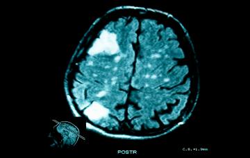 Tumor cerebral Tumores cerebrales