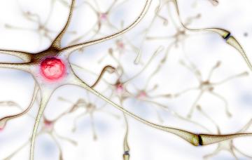 Esclerosis múltiple Esclerosis múltiple