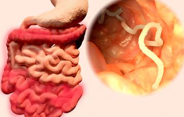 Teniasis Ilustración de una tenia en el intestino