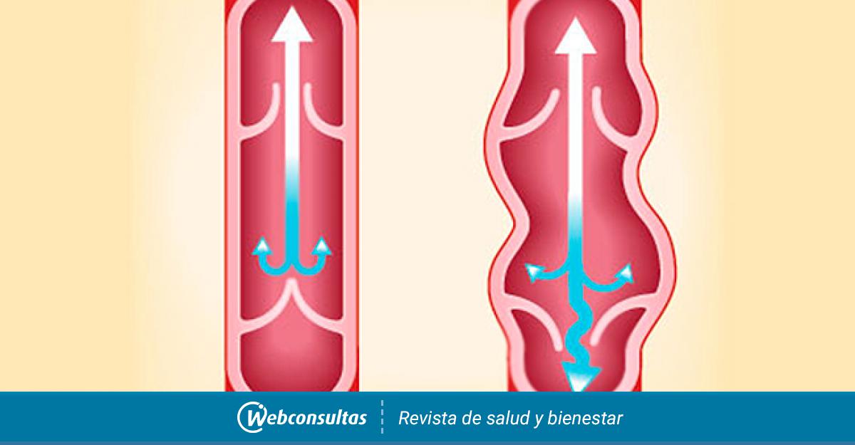 Causas de la trombosis venosa - Salud al día