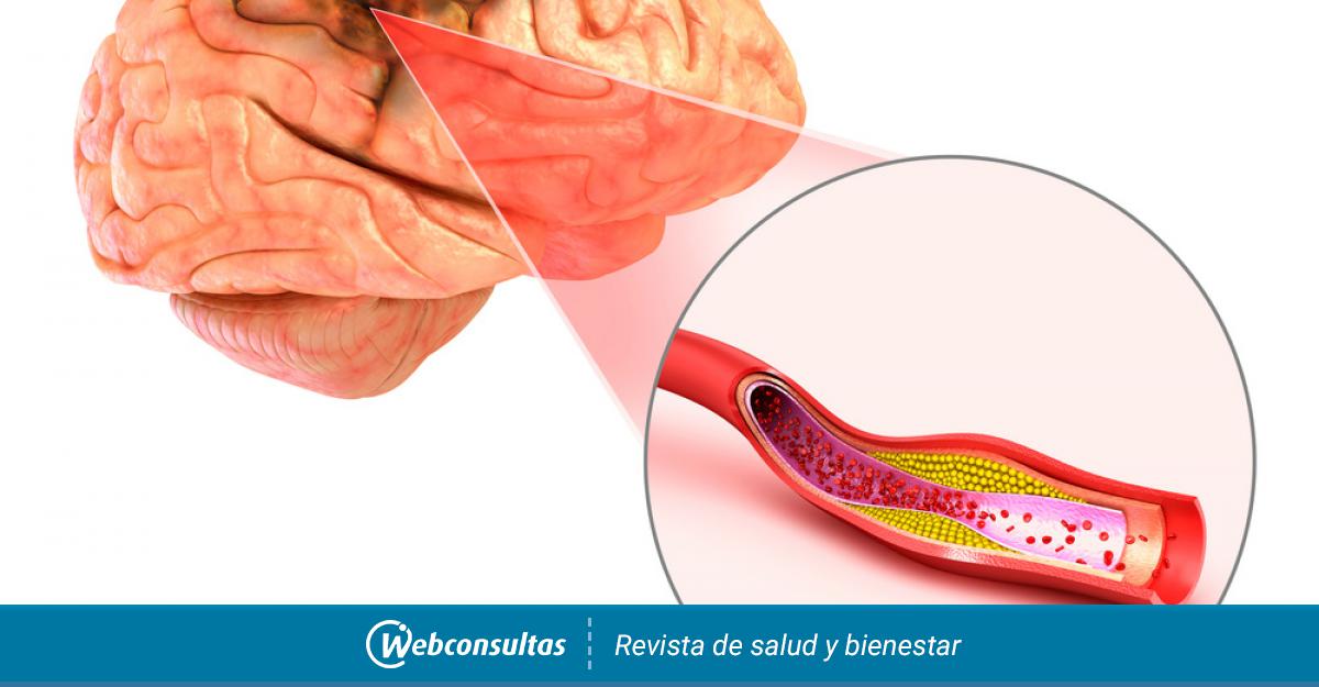 Tipos De Ictus Ictus Isquémico E Ictus Hemorrágico Salud Al Día 9447