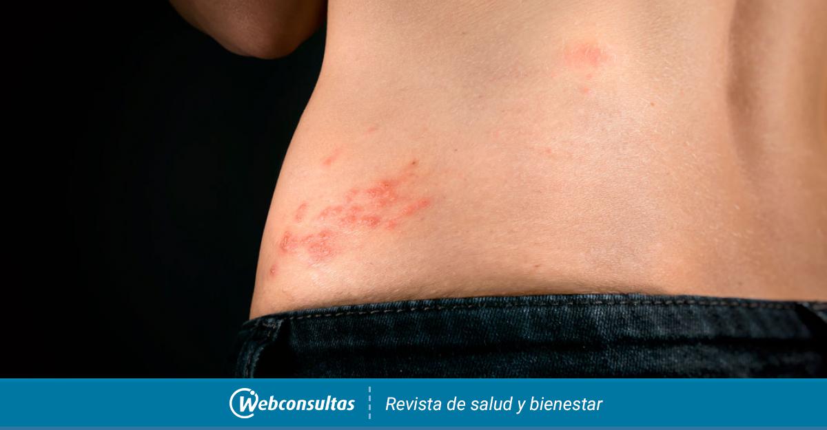 La vacuna contra el herpes zóster ayuda a reducir el ...