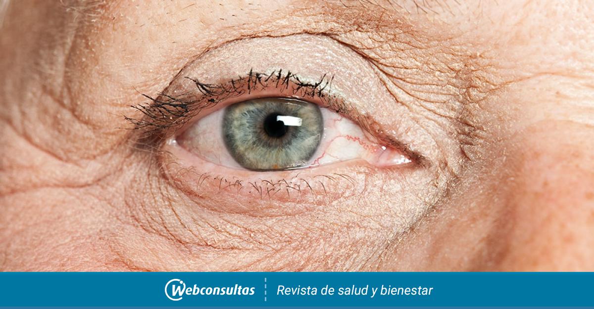 Así se extraen 23 lentes de contacto del ojo de una paciente