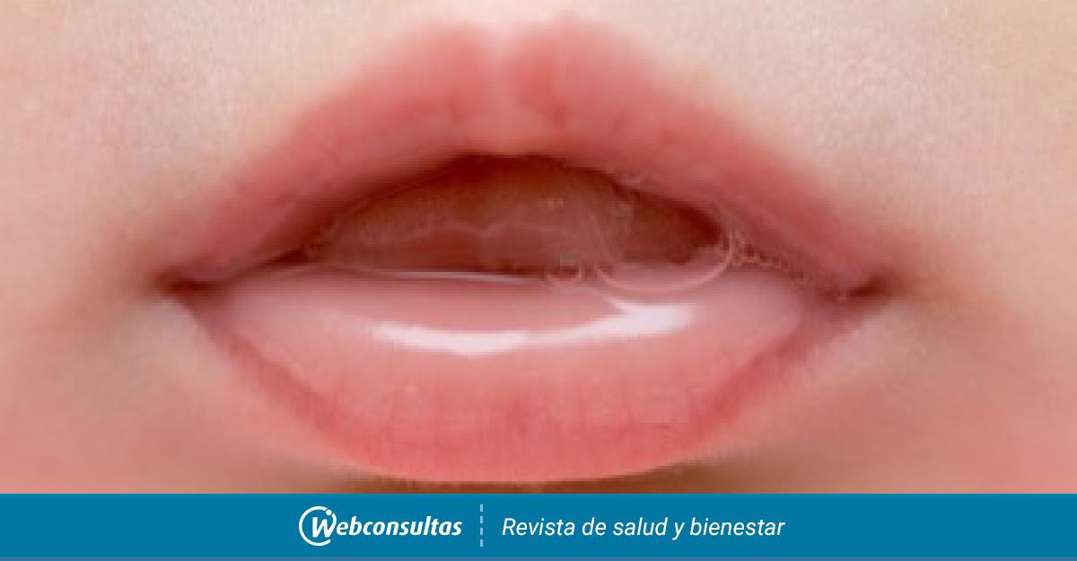 Idean un nuevo tratamiento para el labio leporino