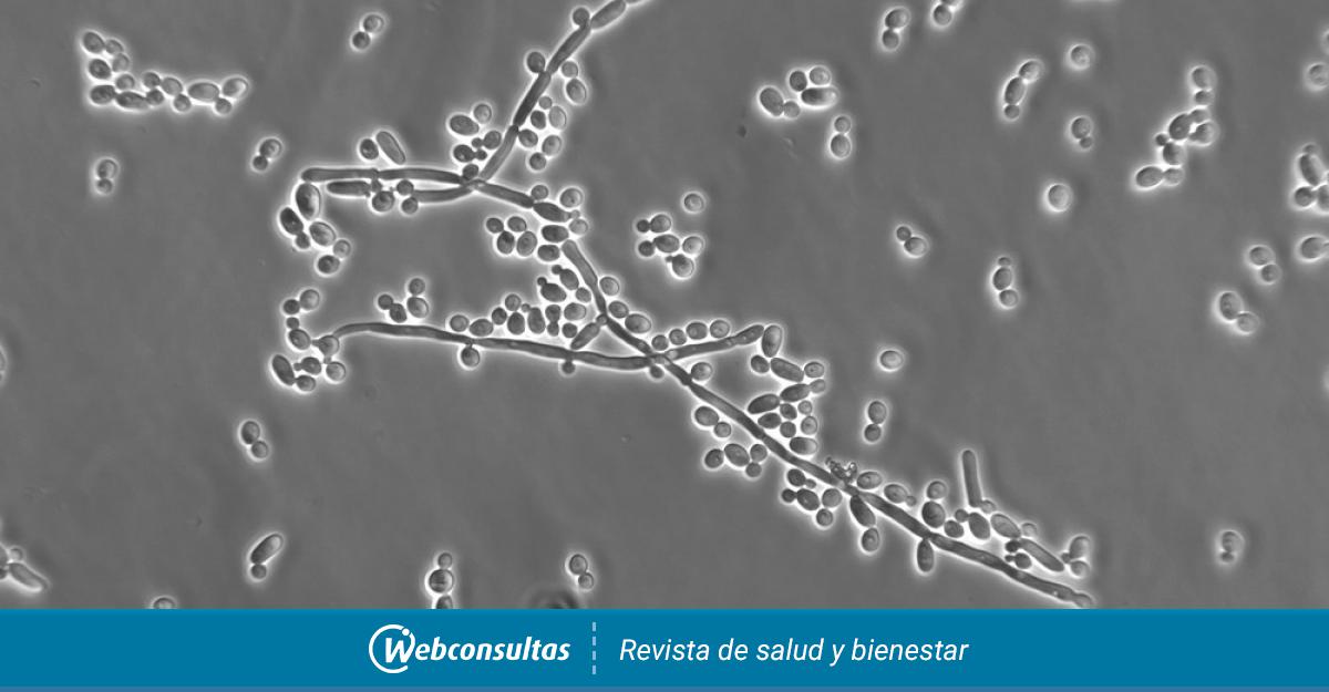 Candidiasis Causas Síntomas Y Tratamiento 0816