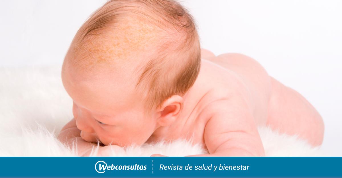 Costra láctea en bebés recién nacidos