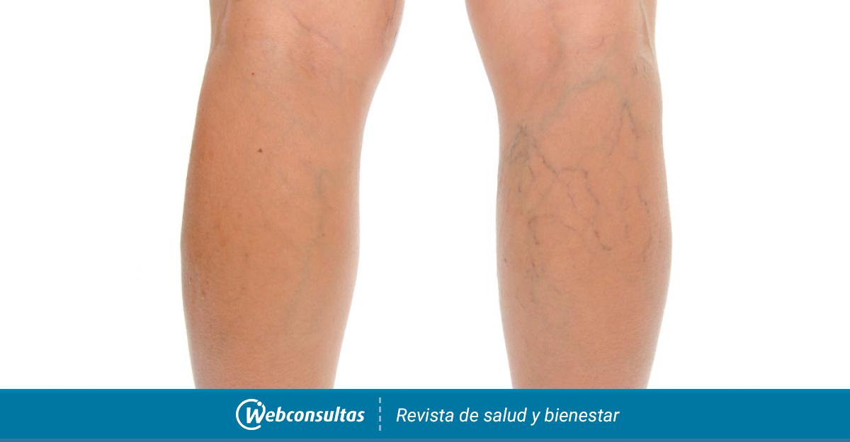 Varices Causas Síntomas Y Tratamiento 0539