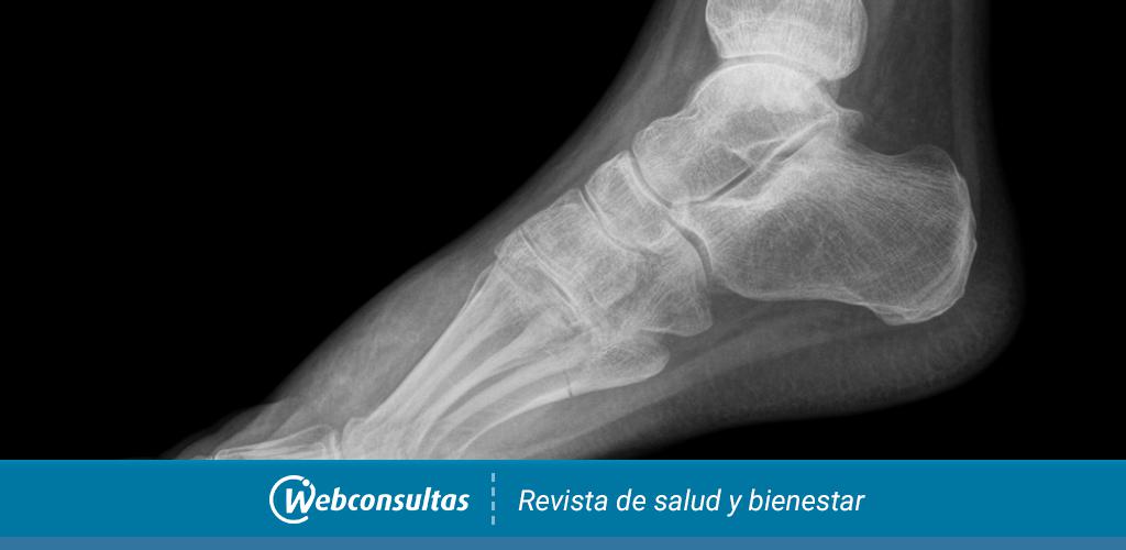 Fascitis Plantar  Clínica Reumatológica Dr. Ponce