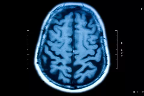 Orientarse y sortear obstáculos es posible para los lesionados cerebrales con pérdida de visión