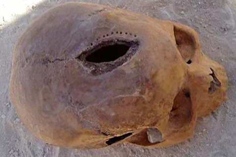 Historia de la trepanación