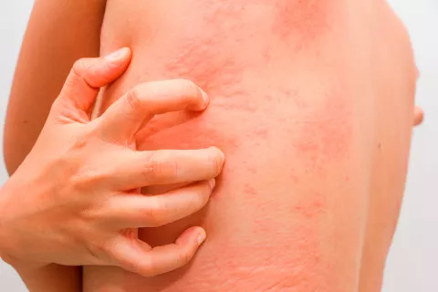 Urticaria acuagénica, alergia al agua