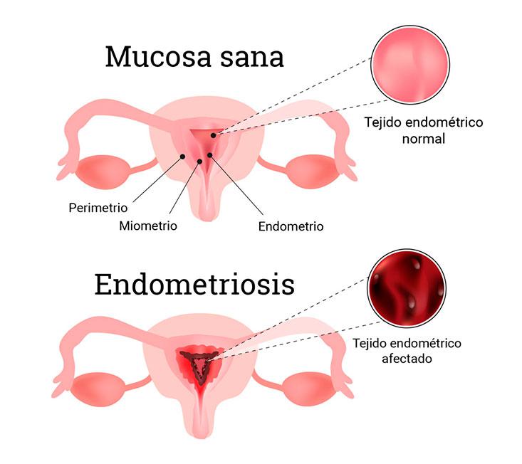 Endometriosis Qué Es Y Qué Lesiones Provoca 0042