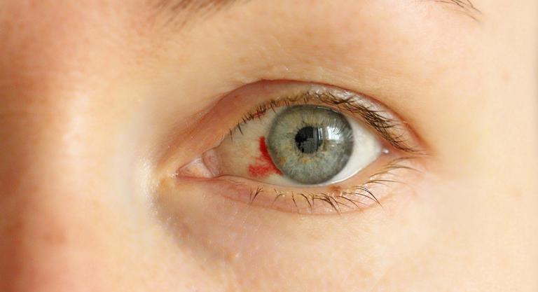 Derrame Ocular Qué Es Y Causas De Hemorragia En El Ojo