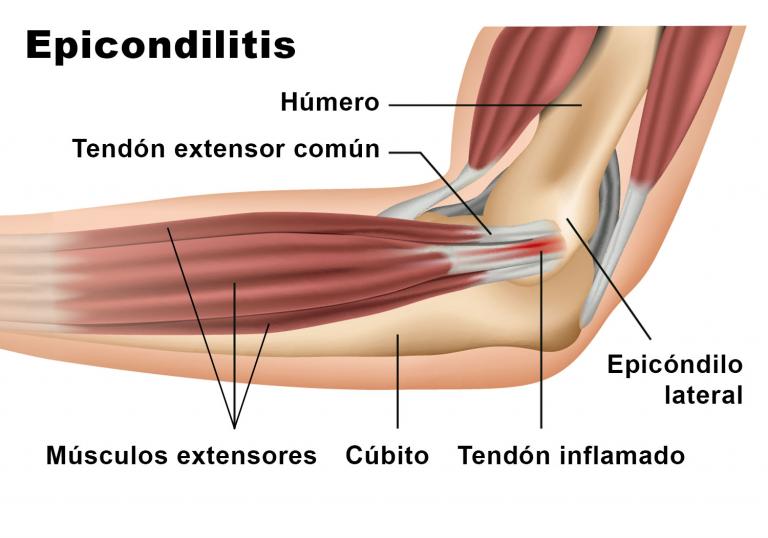 Epicondilitis, ilustración del codo de tenista 