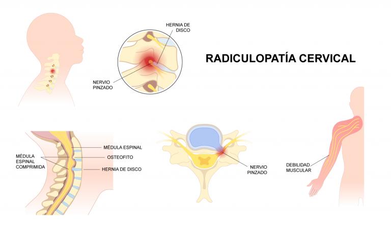 Esquema radiculopatía cervical