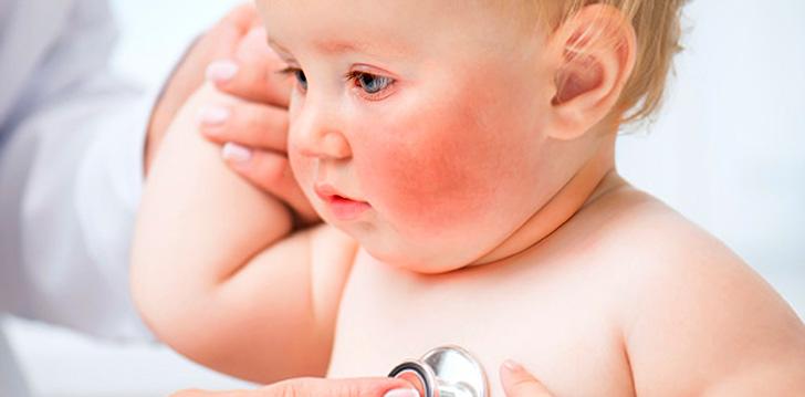 Bebé con el sarpullido típico que ayuda a diagnosticar la quinta enfermedad