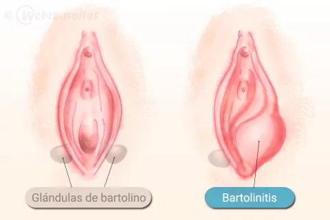 Causas de la bartolinitis