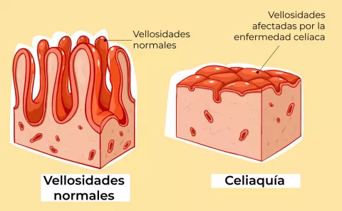 Causas de la celiaquía (ilustración)