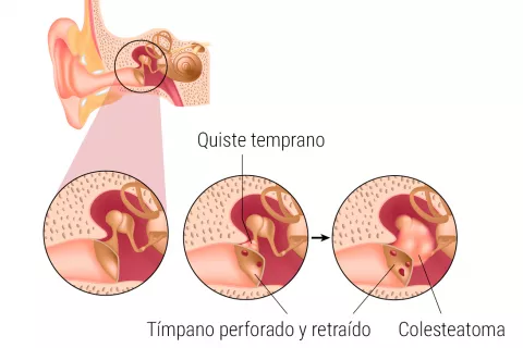 Causas del colesteatoma y tipos