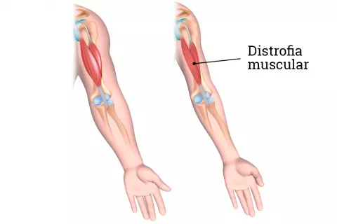 Causas de la contracción muscular en la distrofia muscular de Duchenne