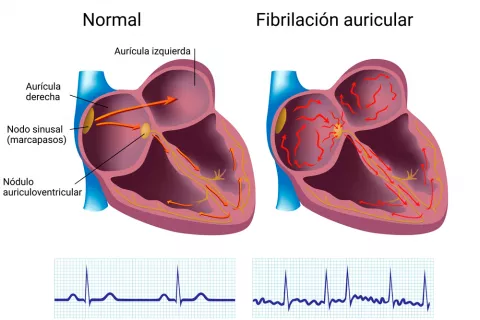 Factores de riesgo de la fibrilación auricular