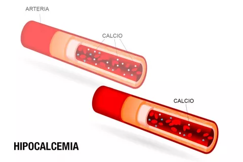 Causas de la hipocalcemia