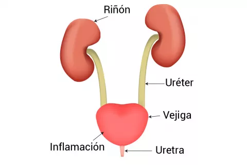 Diagrama de la infección de la vejiga