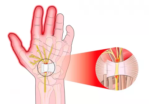 Ilustración de las causas del túnel carpiano