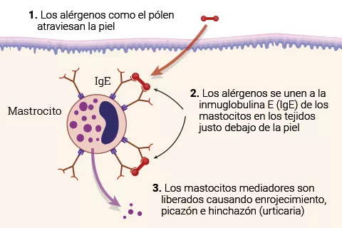 Ilustración de las causas de la urticaria