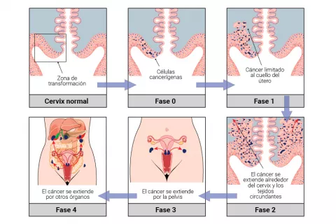 Clasificación del cáncer de cuello de útero