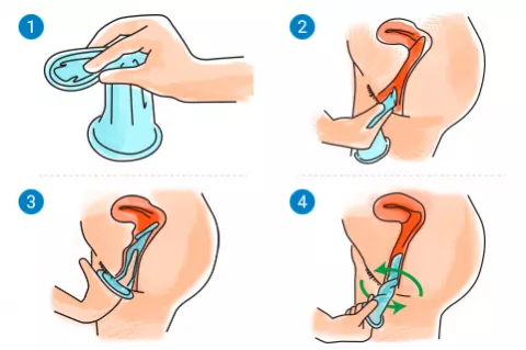 Cómo se pone el condón femenino (ilustración)