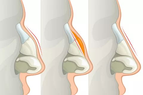 Cómo se realiza una rinoplastia