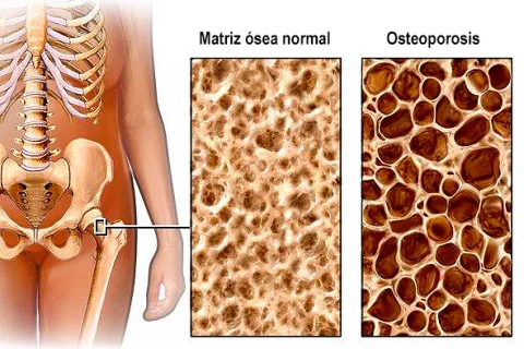 Ilustración de la densidad ósea en la osteoporosis