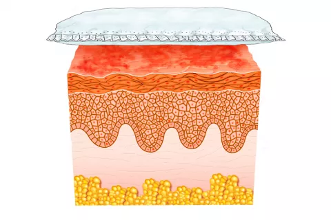 Dermatitis a causa del pañal sucio