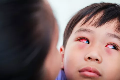 Diagnóstico de la conjuntivitis