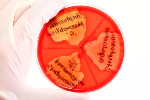 Diagnóstico de la endocarditis