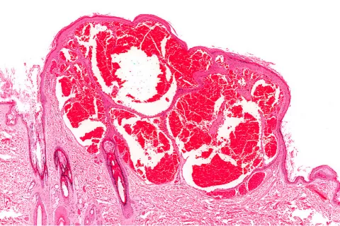 Síntomas y diagnóstico de los hemangiomas