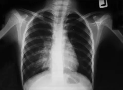 Diagnóstico del neumotórax por radiografía