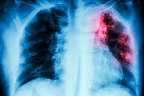 Diagnóstico de sarcoidosis