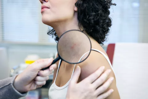 Diagnóstico de urticaria en una mujer