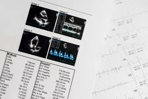 Resultados de un ecocardiograma