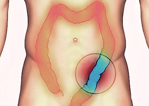 Causas de la colitis ulcerosa